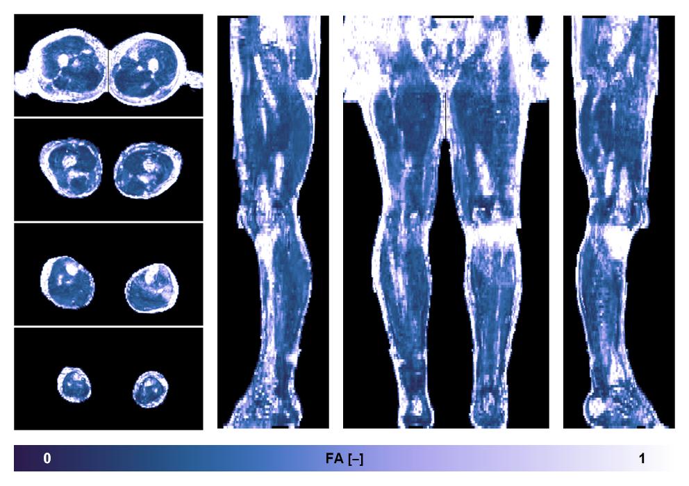 IVIM corrected whole leg muscle fractional anisotropy obtained from diffusion tensor imaging.